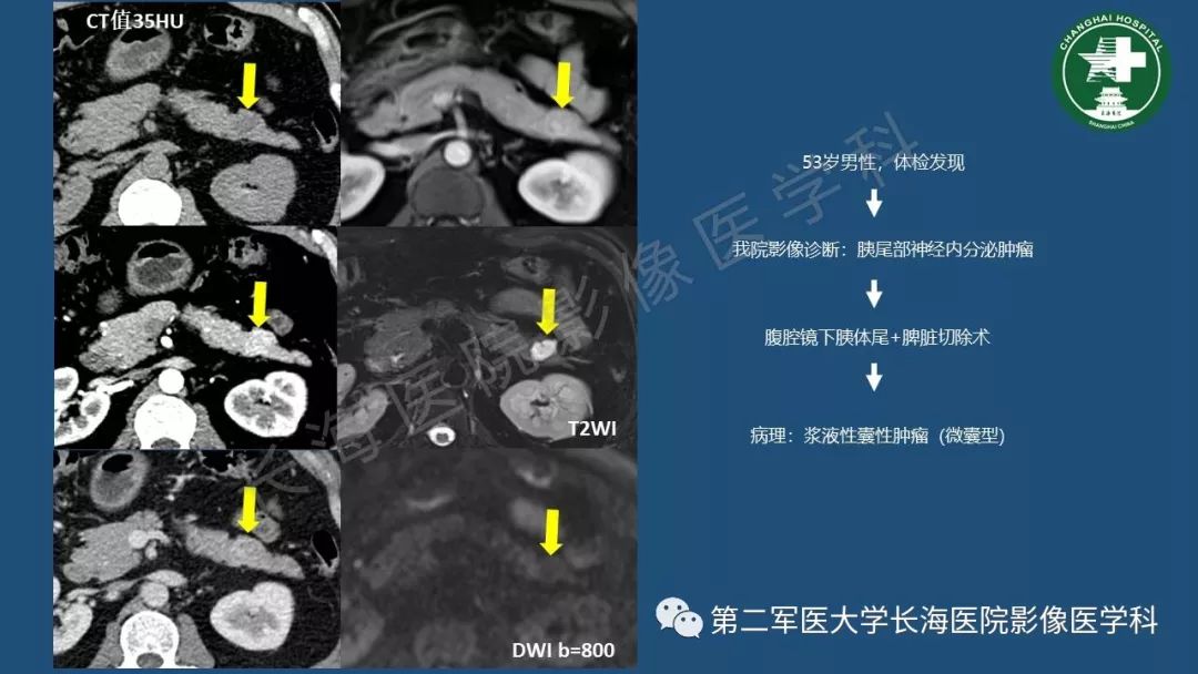 影像PPT - 【PPT】胰腺影像诊断在临床决策中的意义及常见误诊病种-35