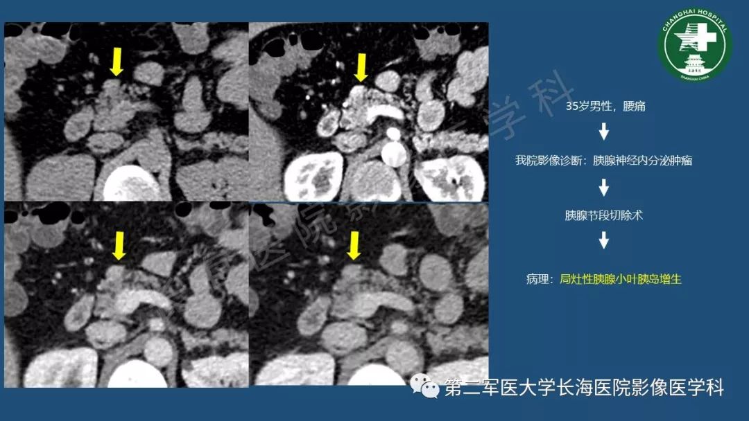 影像PPT - 【PPT】胰腺影像诊断在临床决策中的意义及常见误诊病种-33