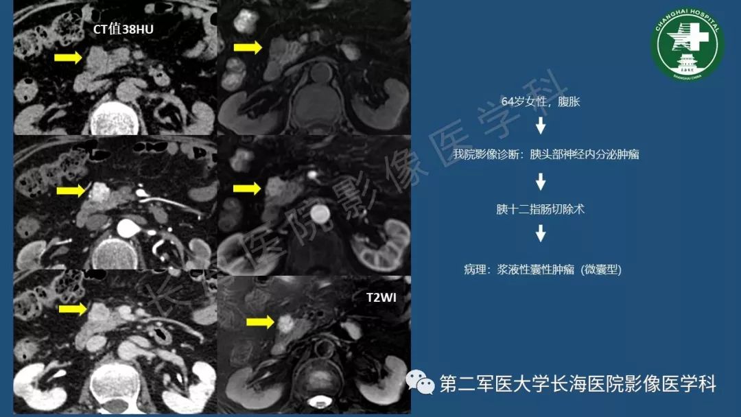 影像PPT - 【PPT】胰腺影像诊断在临床决策中的意义及常见误诊病种-36