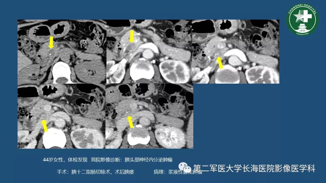 影像PPT - 【PPT】胰腺影像诊断在临床决策中的意义及常见误诊病种-37