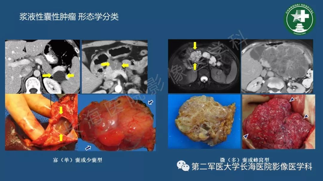 影像PPT - 【PPT】胰腺影像诊断在临床决策中的意义及常见误诊病种-38
