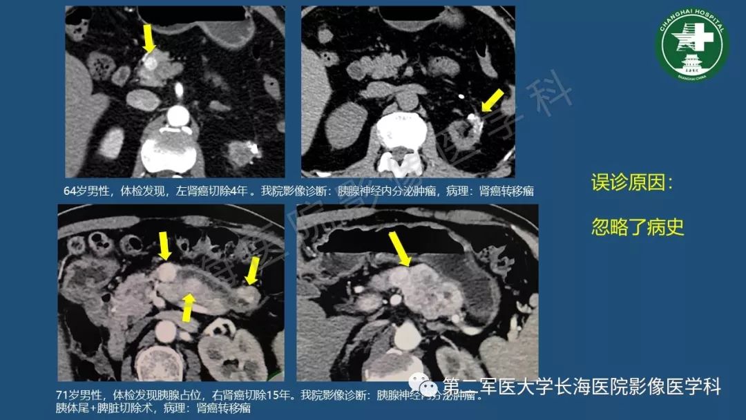 影像PPT - 【PPT】胰腺影像诊断在临床决策中的意义及常见误诊病种-41
