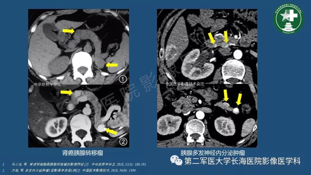 影像PPT - 【PPT】胰腺影像诊断在临床决策中的意义及常见误诊病种-42