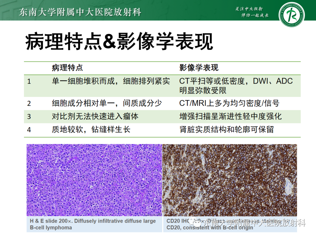 影像PPT - 【PPT】肾脏淋巴瘤-9