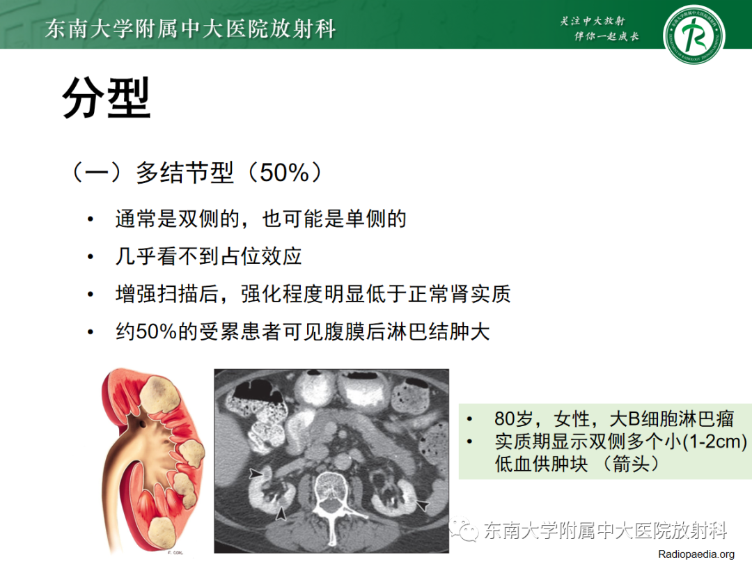 影像PPT - 【PPT】肾脏淋巴瘤-13