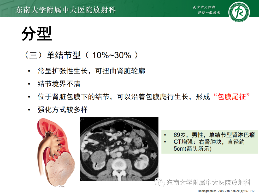 影像PPT - 【PPT】肾脏淋巴瘤-15