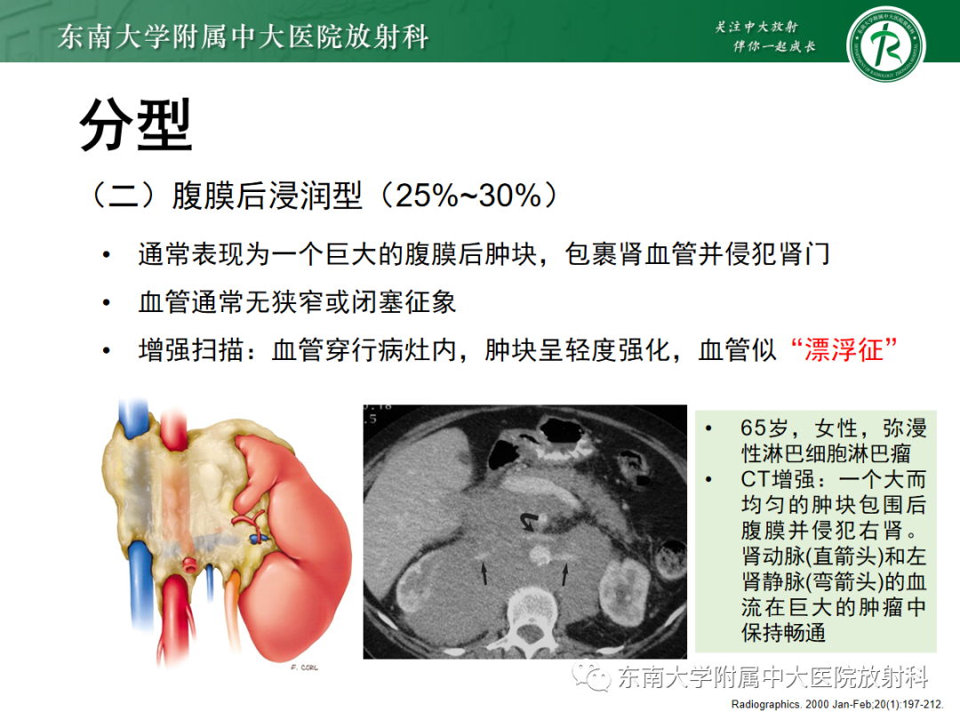 影像PPT - 【PPT】肾脏淋巴瘤-14