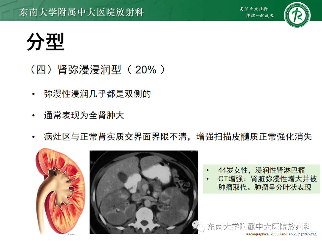影像PPT - 【PPT】肾脏淋巴瘤-16