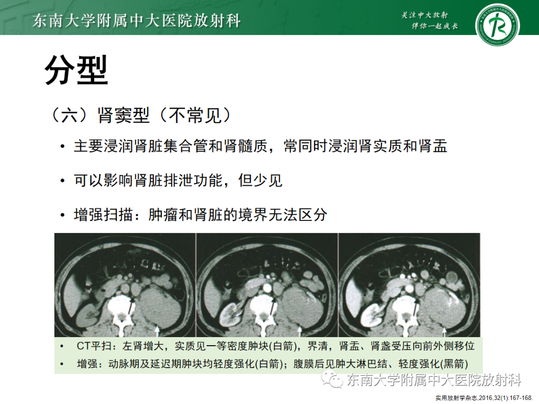 影像PPT - 【PPT】肾脏淋巴瘤-18