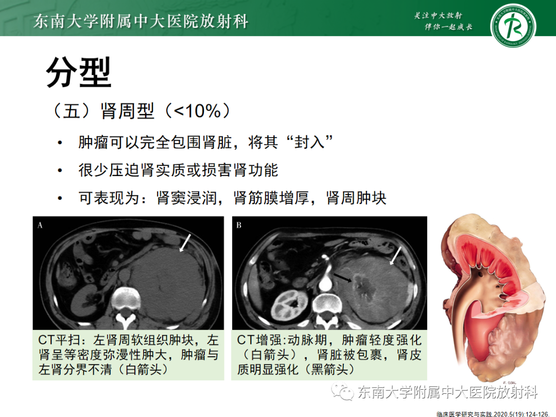 影像PPT - 【PPT】肾脏淋巴瘤-17