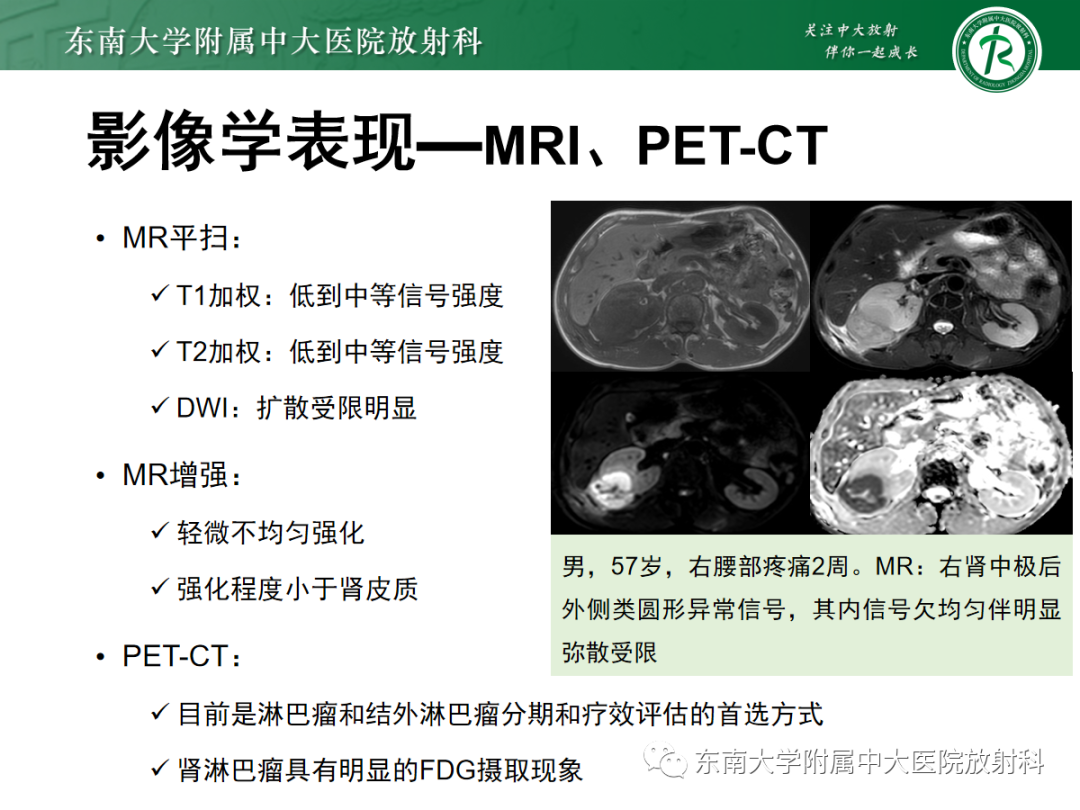 影像PPT - 【PPT】肾脏淋巴瘤-19