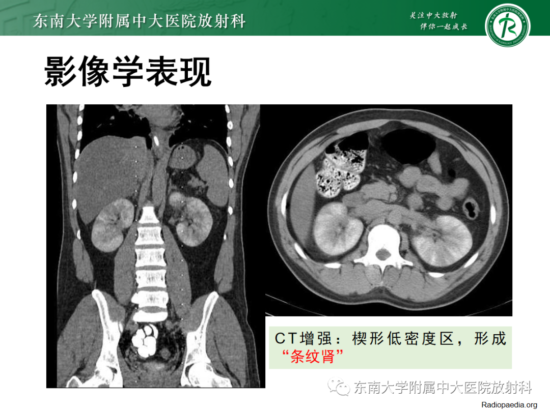影像PPT - 【PPT】肾脏淋巴瘤-22
