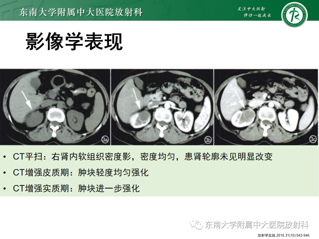 影像PPT - 【PPT】肾脏淋巴瘤-24