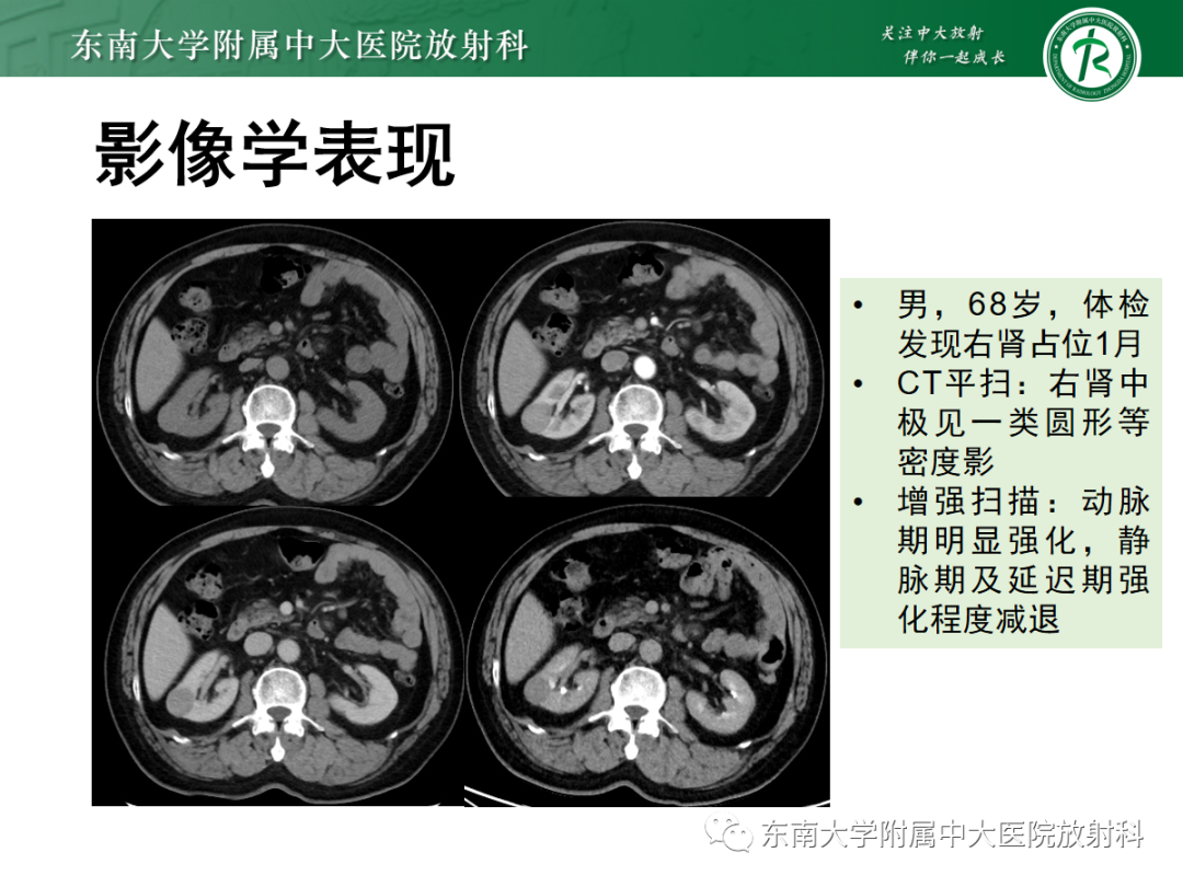 影像PPT - 【PPT】肾脏淋巴瘤-26