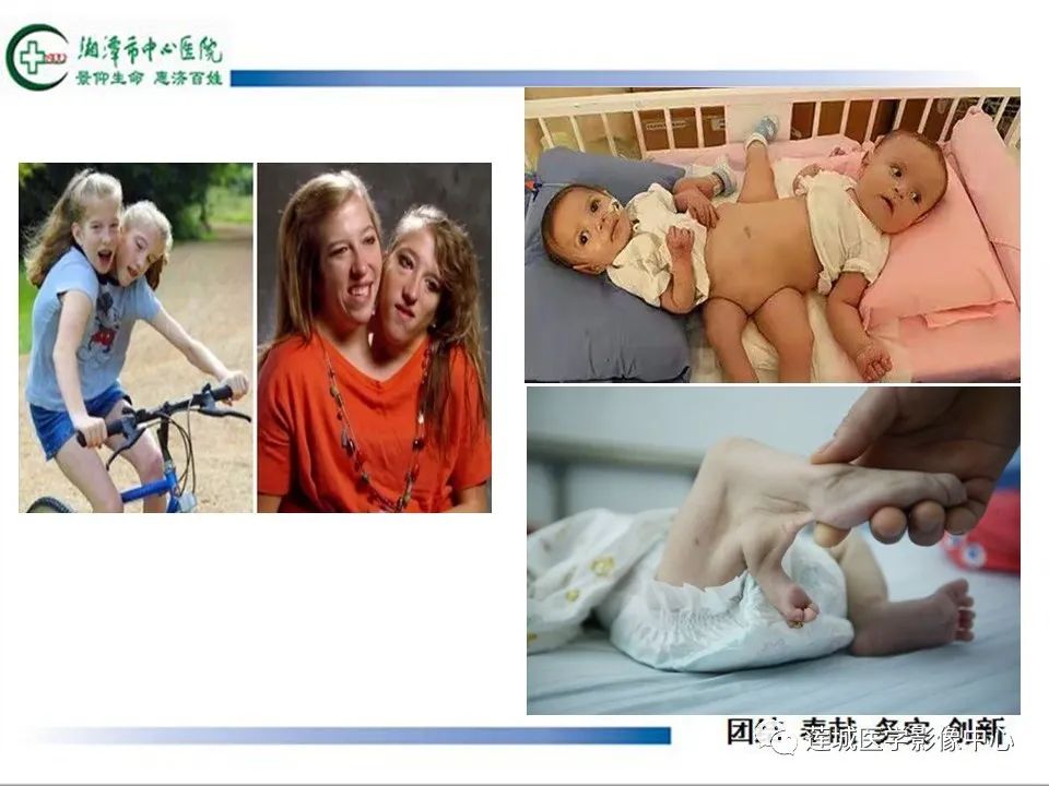 影像PPT - 【PPT】腹腔寄生胎影像表现-5