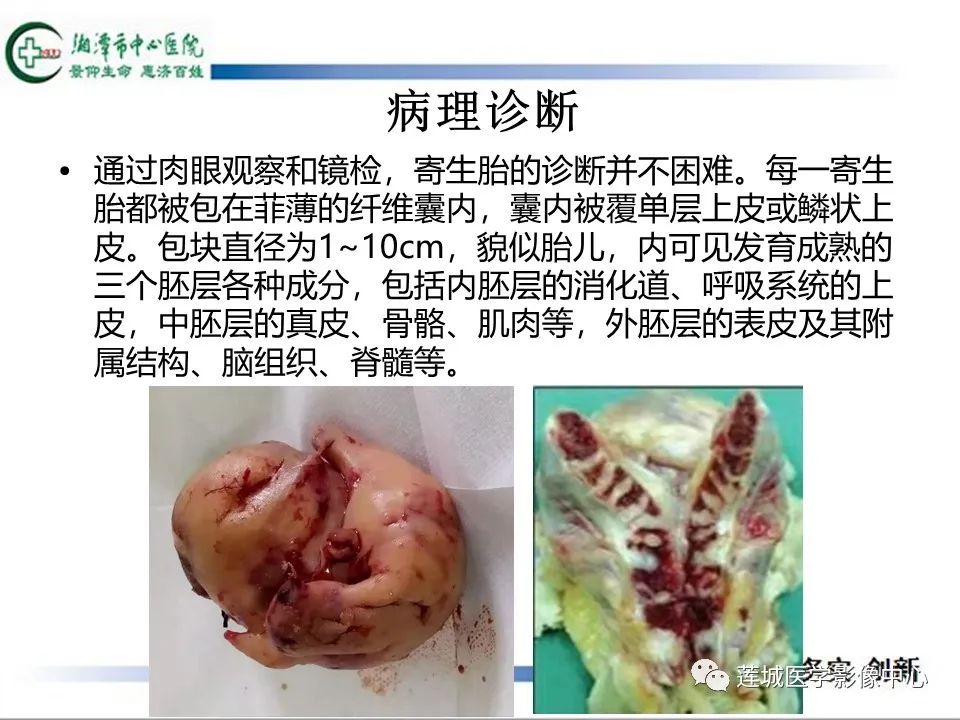 影像PPT - 【PPT】腹腔寄生胎影像表现-7