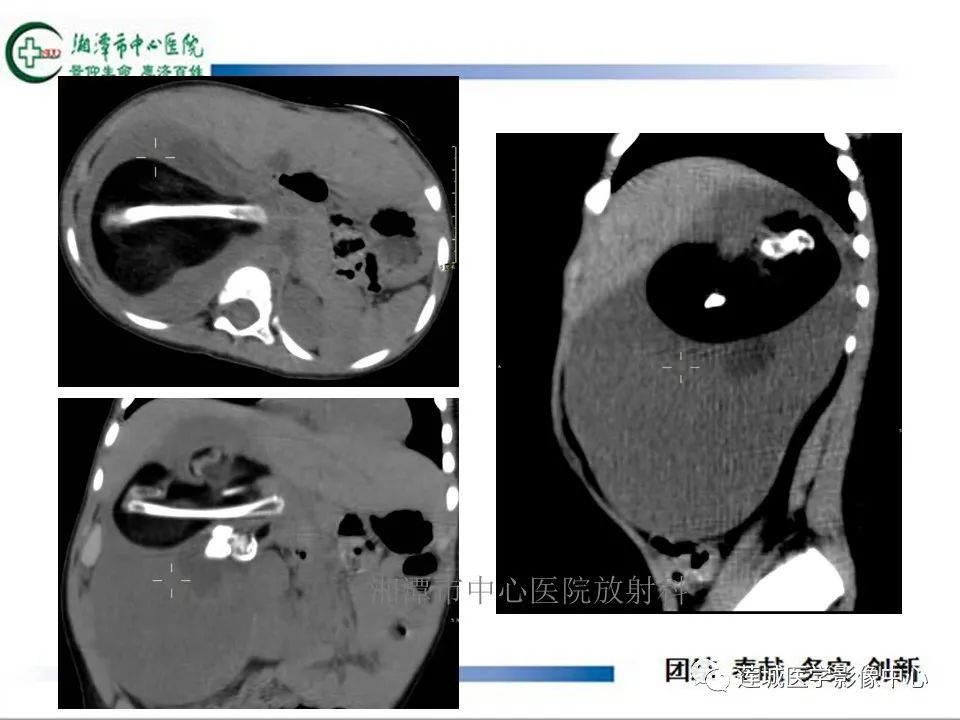 影像PPT - 【PPT】腹腔寄生胎影像表现-11