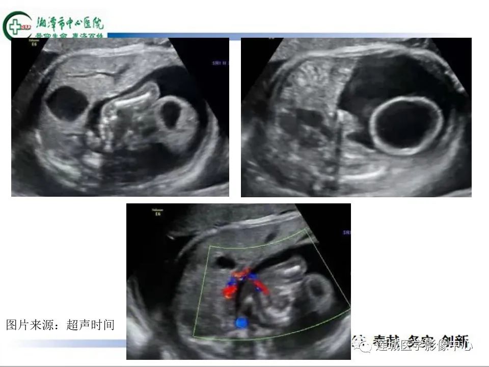 影像PPT - 【PPT】腹腔寄生胎影像表现-13