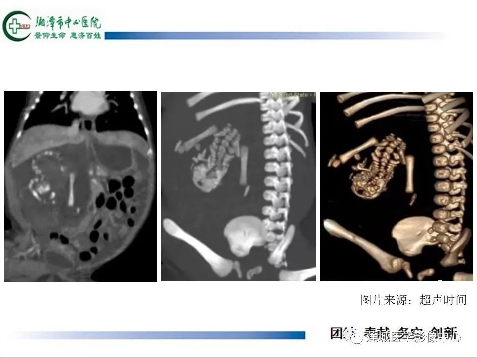 影像PPT - 【PPT】腹腔寄生胎影像表现-15