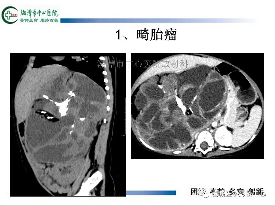 影像PPT - 【PPT】腹腔寄生胎影像表现-17