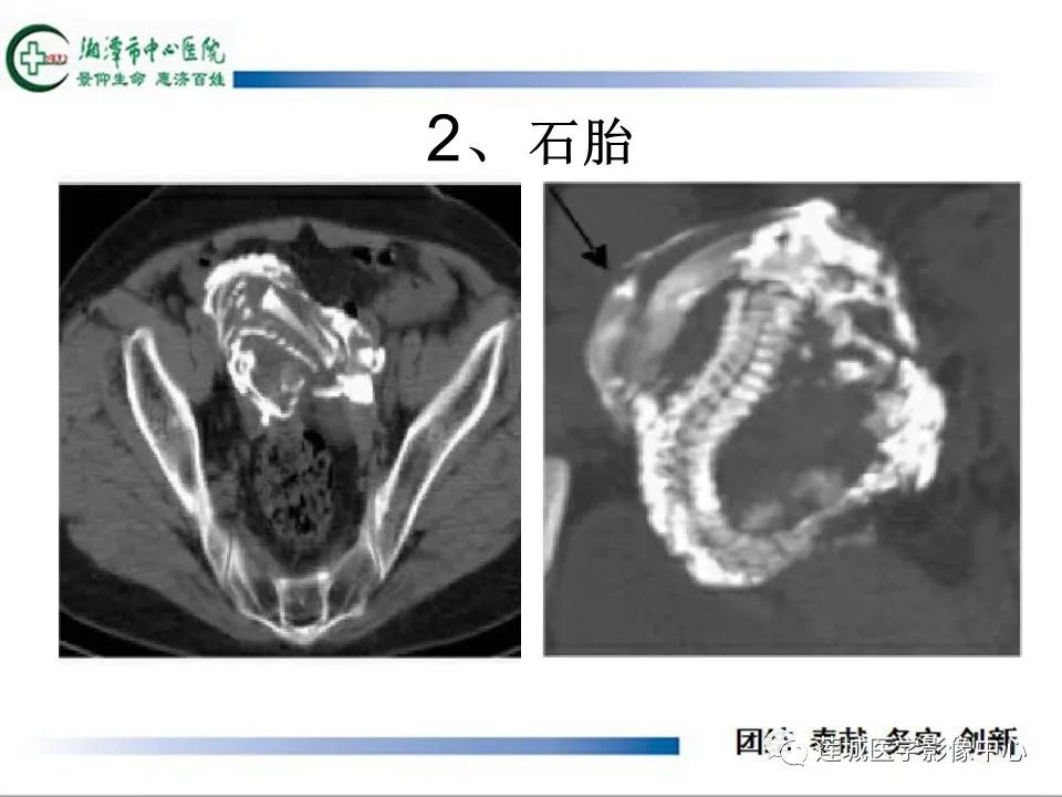 影像PPT - 【PPT】腹腔寄生胎影像表现-20