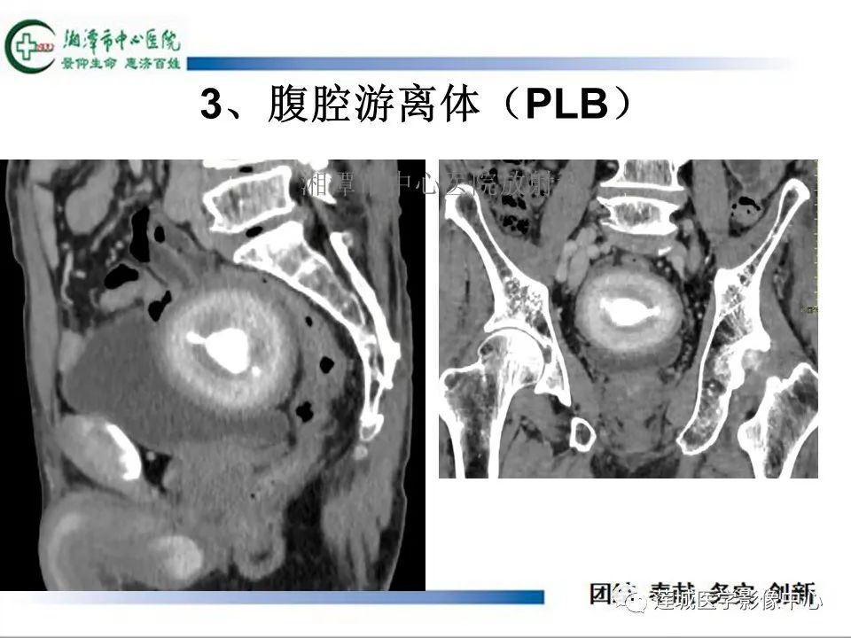 影像PPT - 【PPT】腹腔寄生胎影像表现-23