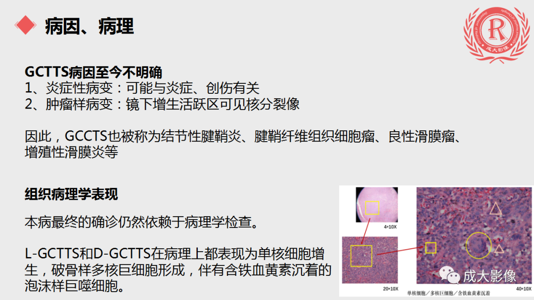 影像PPT - 【PPT】腱鞘巨细胞瘤影像诊断及鉴别诊断-3