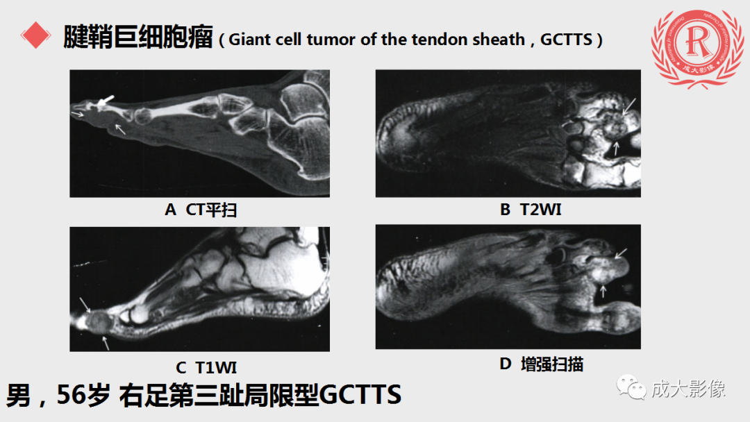 影像PPT - 【PPT】腱鞘巨细胞瘤影像诊断及鉴别诊断-7