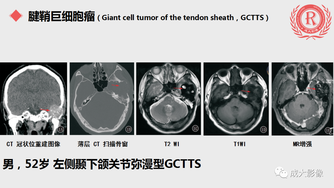 影像PPT - 【PPT】腱鞘巨细胞瘤影像诊断及鉴别诊断-8