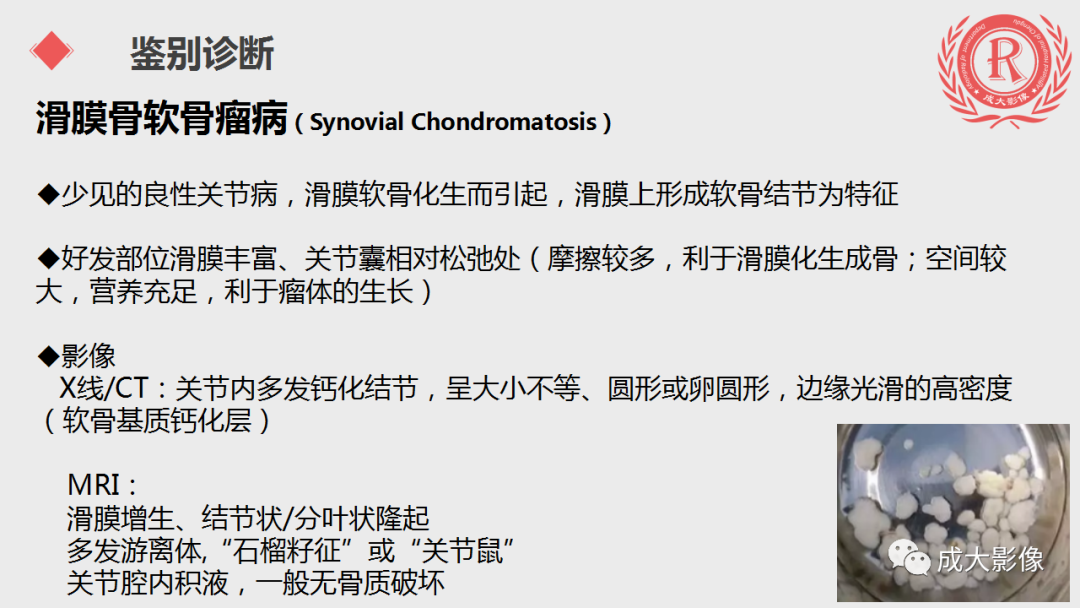 影像PPT - 【PPT】腱鞘巨细胞瘤影像诊断及鉴别诊断-9