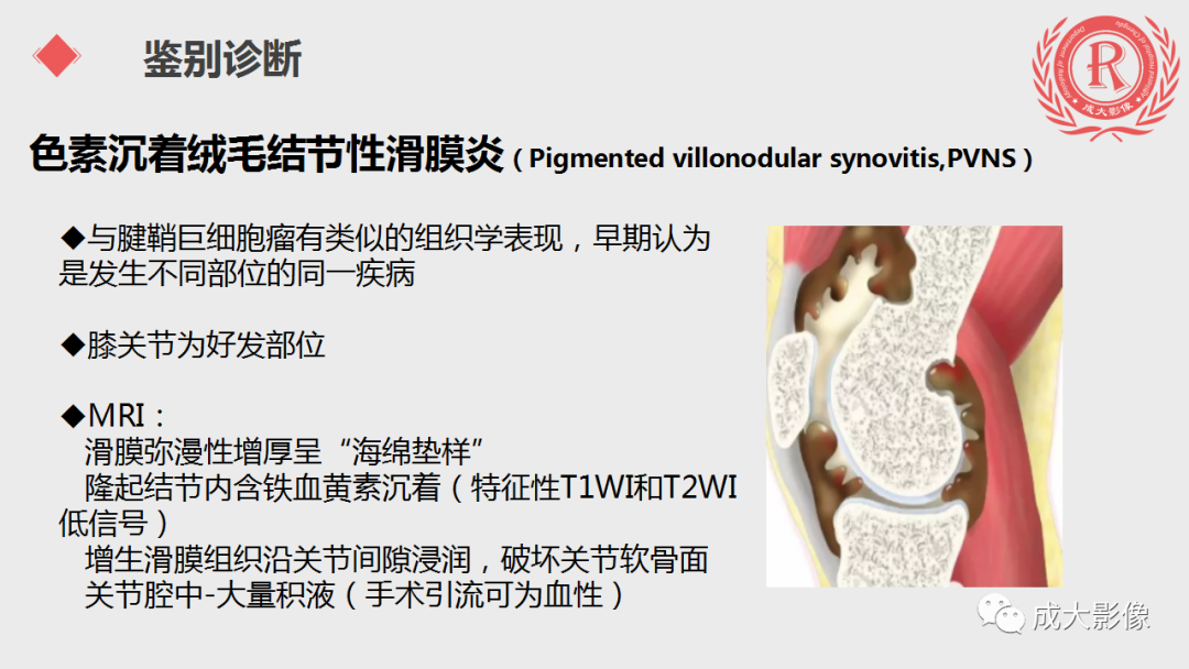 影像PPT - 【PPT】腱鞘巨细胞瘤影像诊断及鉴别诊断-11