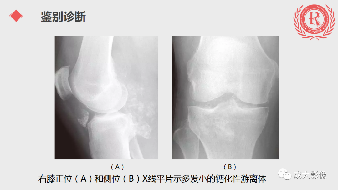 影像PPT - 【PPT】腱鞘巨细胞瘤影像诊断及鉴别诊断-10