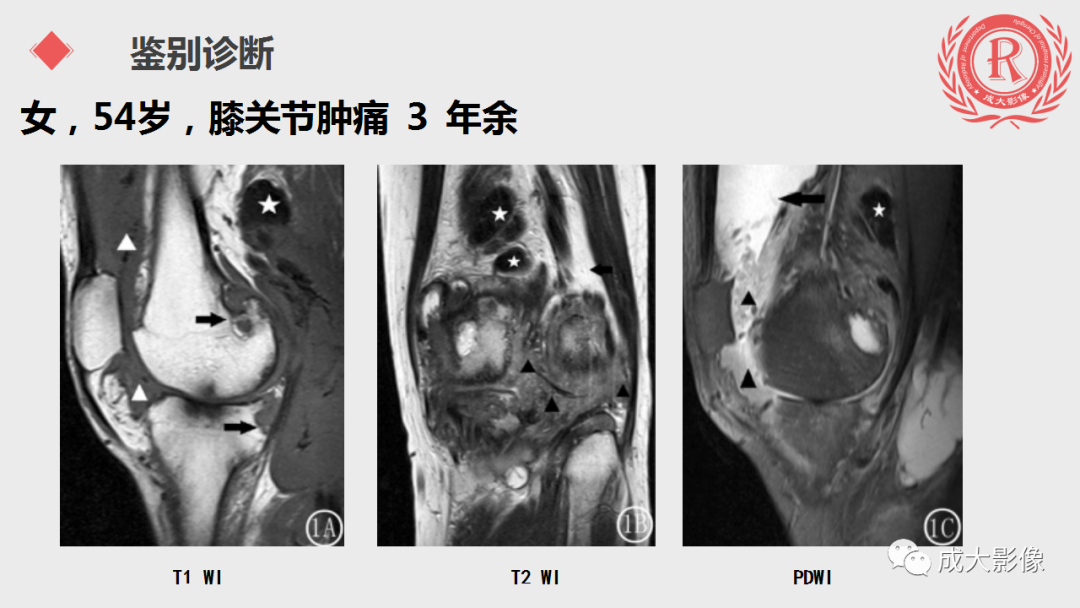 影像PPT - 【PPT】腱鞘巨细胞瘤影像诊断及鉴别诊断-12