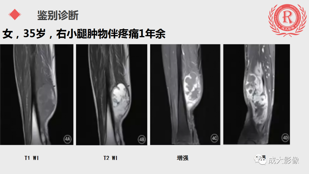 影像PPT - 【PPT】腱鞘巨细胞瘤影像诊断及鉴别诊断-15