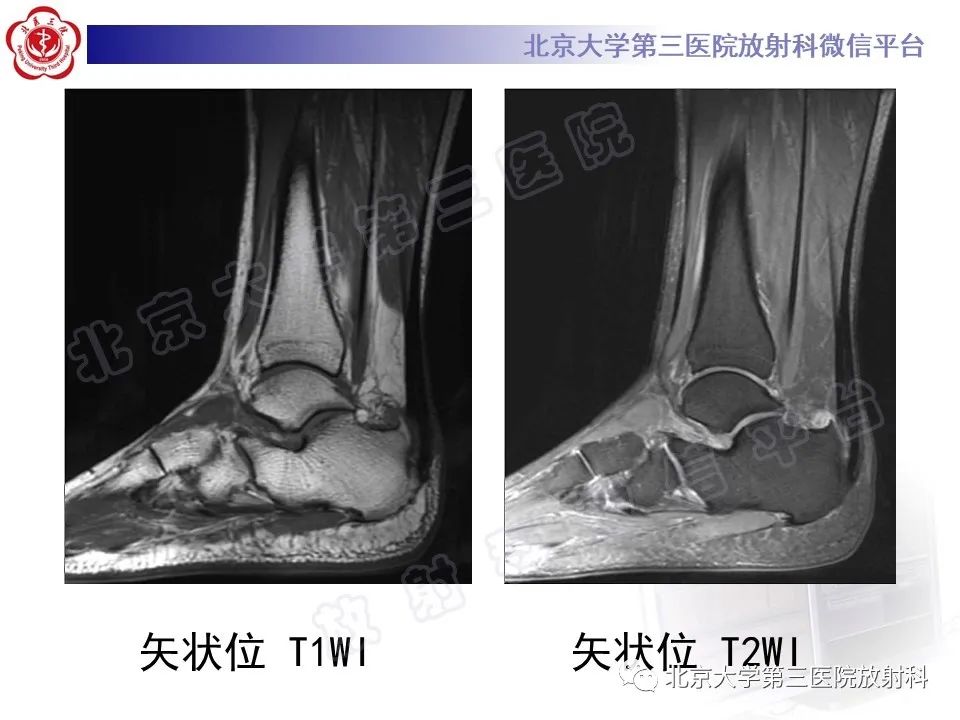 影像PPT - 【PPT】HUGLUND综合征-3