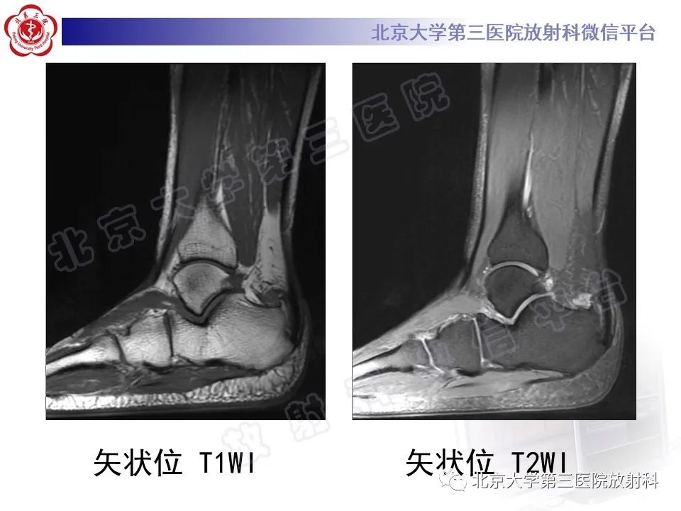 影像PPT - 【PPT】HUGLUND综合征-4