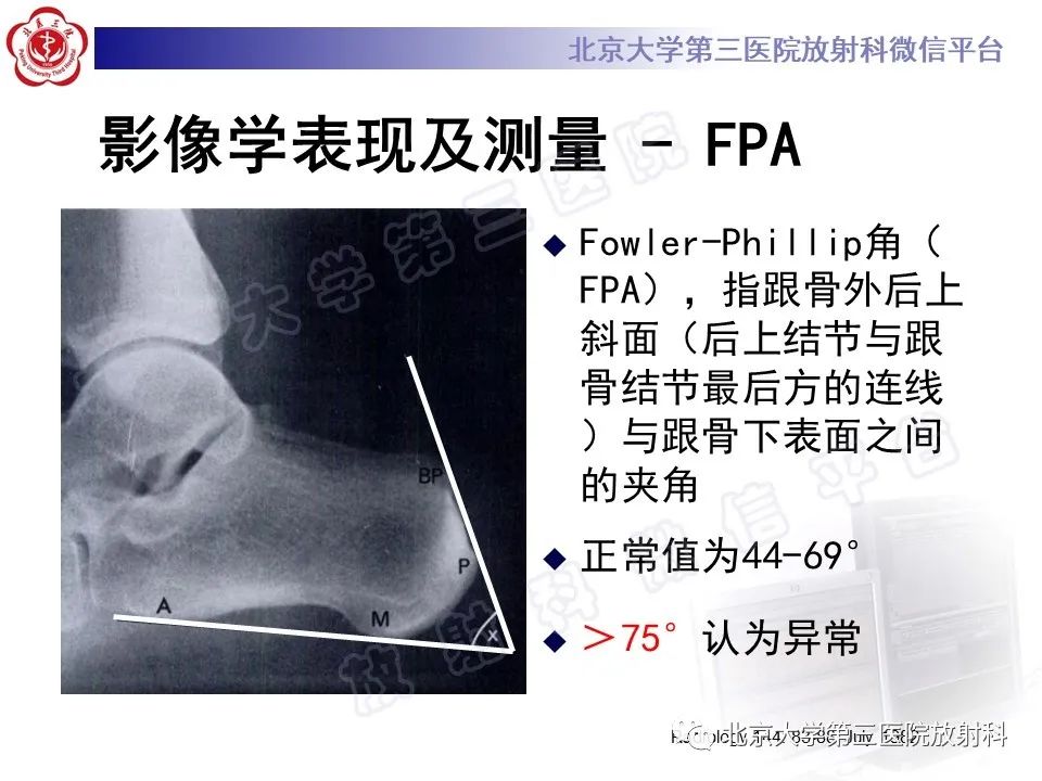 影像PPT - 【PPT】HUGLUND综合征-15