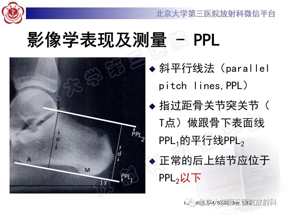 影像PPT - 【PPT】HUGLUND综合征-17