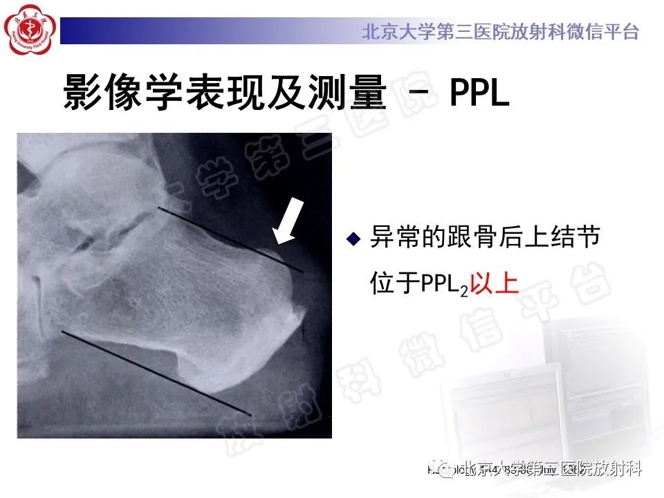 影像PPT - 【PPT】HUGLUND综合征-18