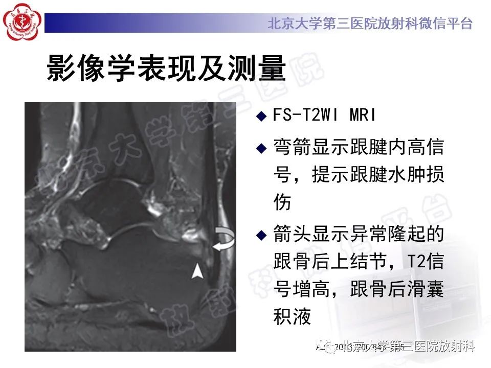 影像PPT - 【PPT】HUGLUND综合征-19