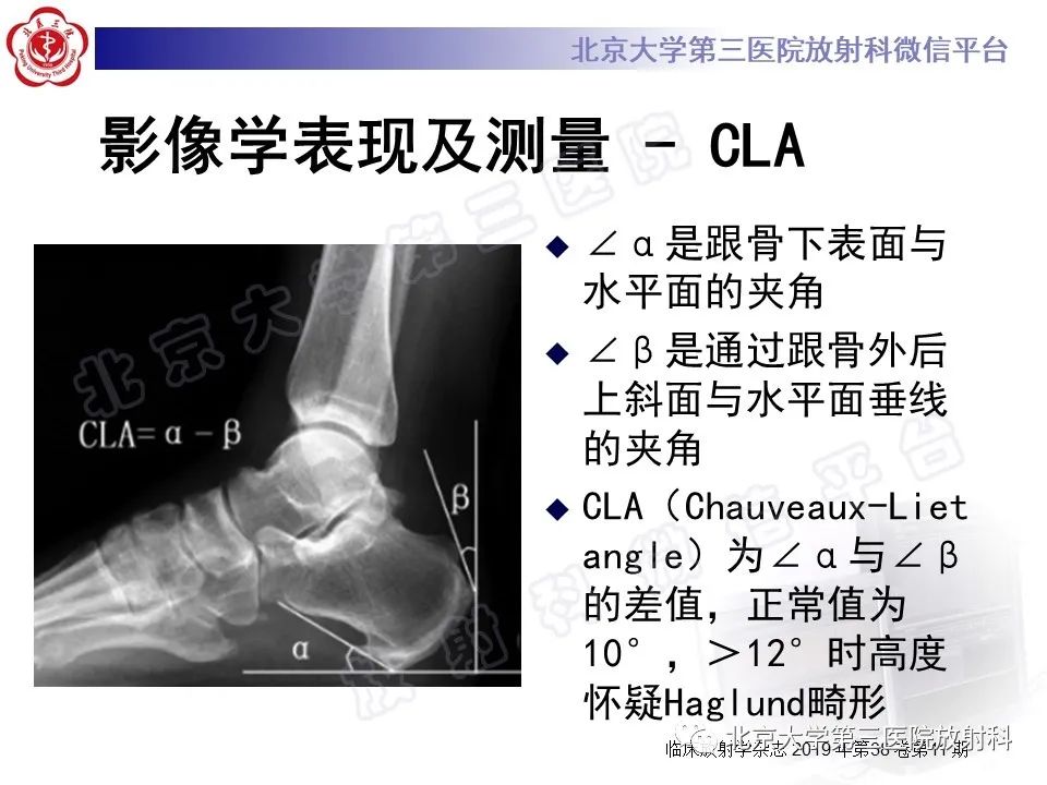 影像PPT - 【PPT】HUGLUND综合征-16