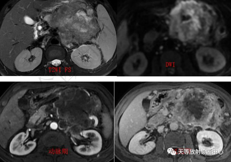 影像PPT - 【病例】胰腺腺泡细胞癌1例CT影像-7