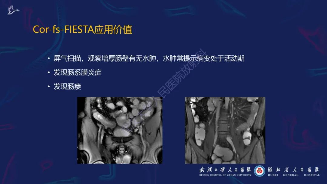 影像PPT - 【PPT】炎症性肠病影像诊断-9