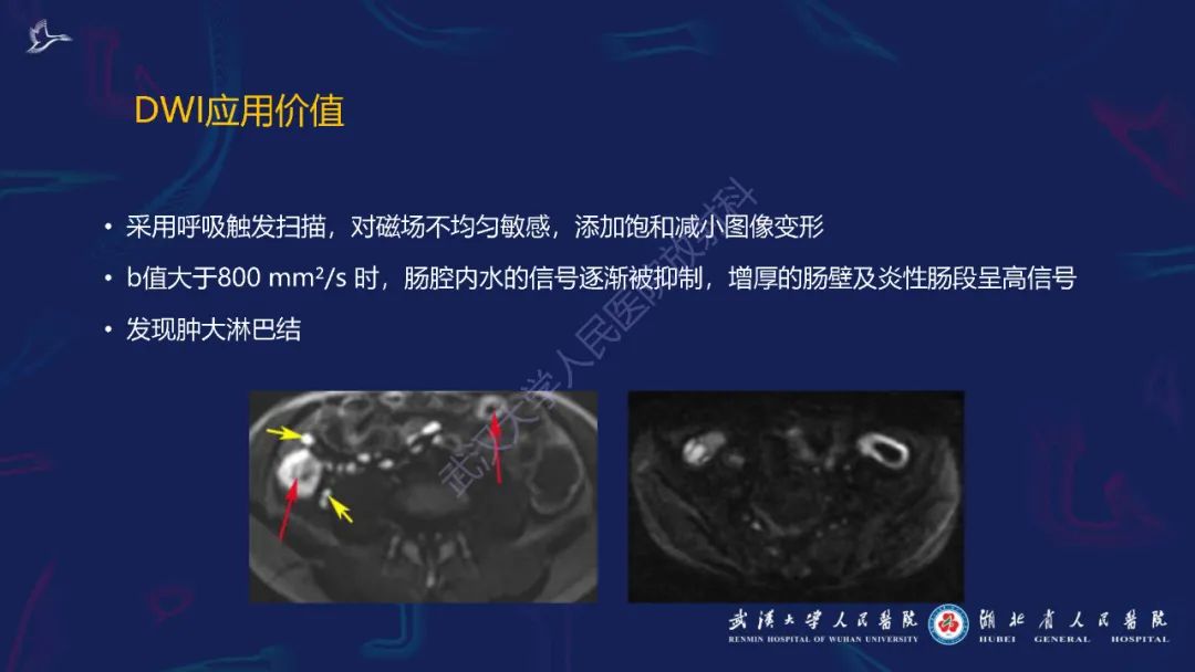 影像PPT - 【PPT】炎症性肠病影像诊断-10