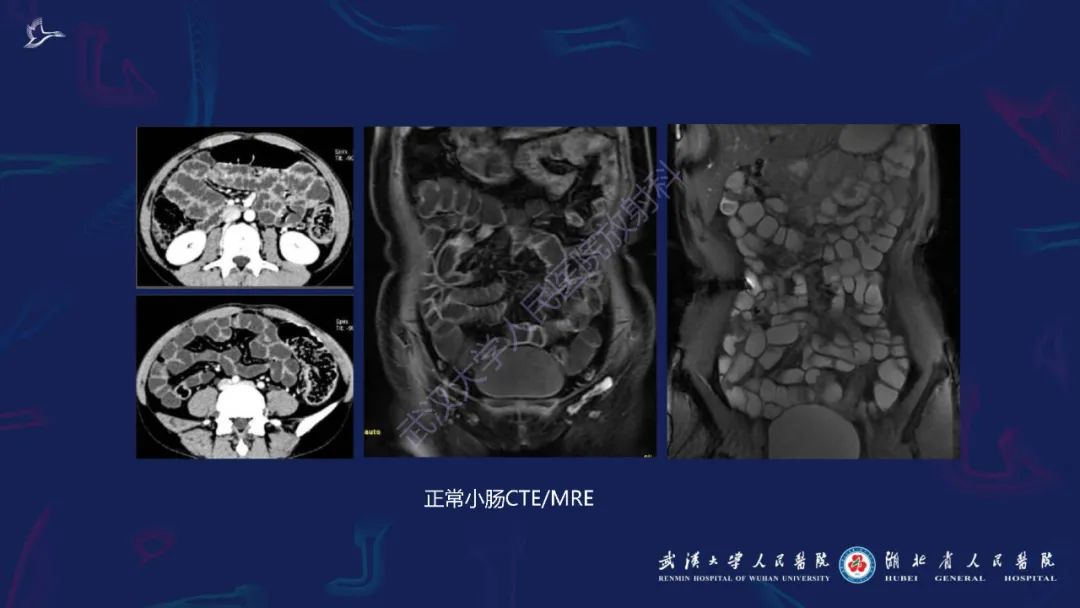影像PPT - 【PPT】炎症性肠病影像诊断-13