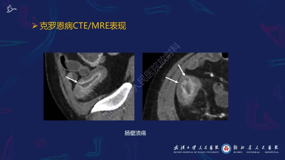 影像PPT - 【PPT】炎症性肠病影像诊断-17