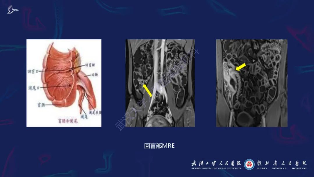 影像PPT - 【PPT】炎症性肠病影像诊断-14