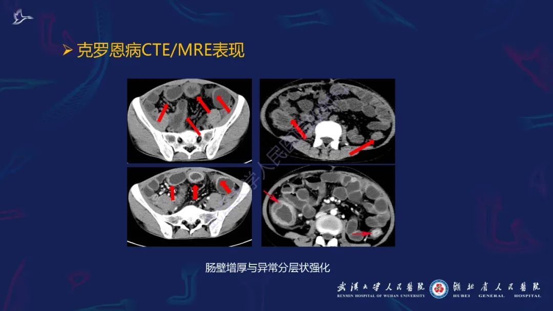 影像PPT - 【PPT】炎症性肠病影像诊断-16