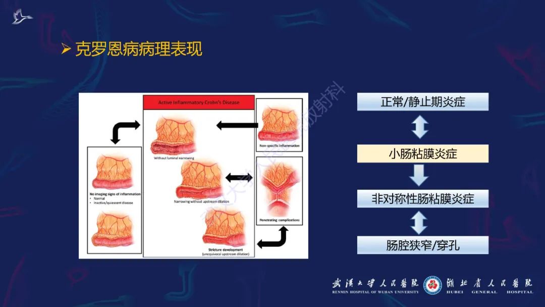 影像PPT - 【PPT】炎症性肠病影像诊断-15