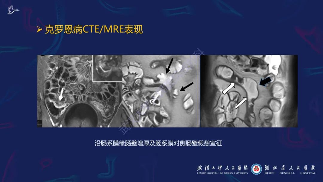 影像PPT - 【PPT】炎症性肠病影像诊断-19